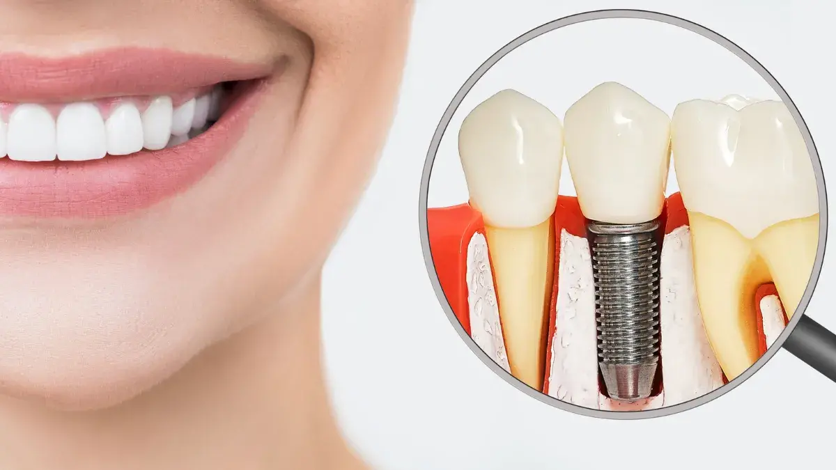 o que comer após implante dentário