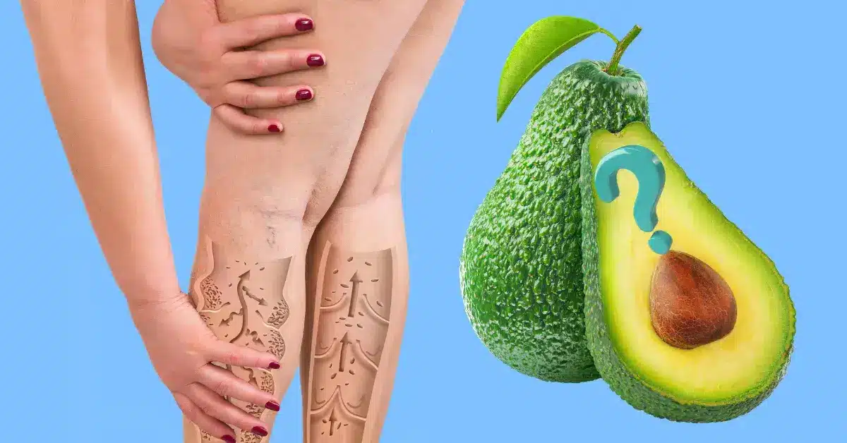 caroço de abacate para varizes