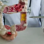 Diverticulite tem cura ou não Entenda os sintomas, causas e tratamento
