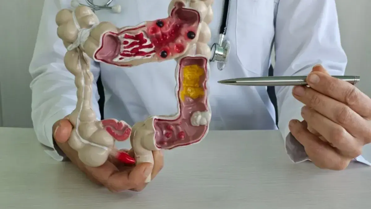 Diverticulite tem cura ou não Entenda os sintomas, causas e tratamento