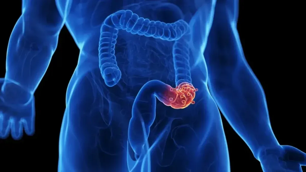 diverticulite e seus sintomas no intestino grosso