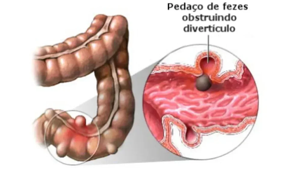 O que Causa a Diverticulite